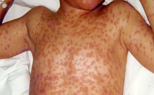 দেশে আশঙ্কাজনক হারে বাড়ছে হামের প্রকোপ: ২৪ ঘণ্টায় আরও ৫ মৃত্যু, টিকাদানে সংকটের অভিযোগ